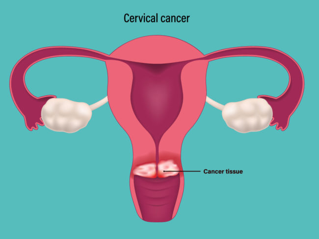 Illustration of female reproductive system with cancer tissue on the cervix