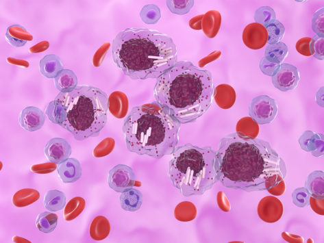 Chronic lymphocytic leukemia cll