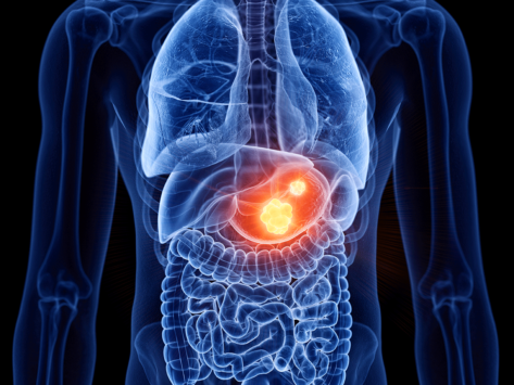 Gastric cancer illustration