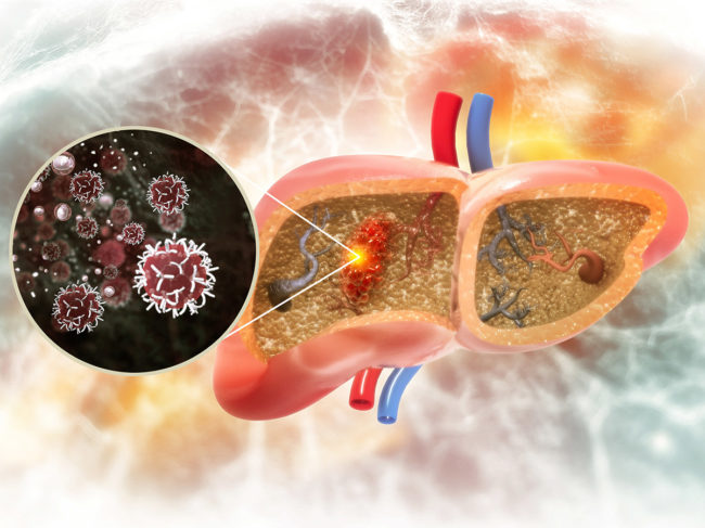 Illustration of tumor in the liver