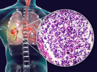 Small-cell lung cancer under microscope with 3D illustration