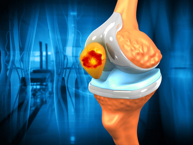 Illustration of knee joint, giant cell tumor of bone