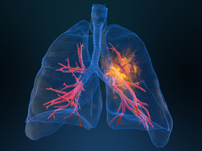 Lung cancer illustration