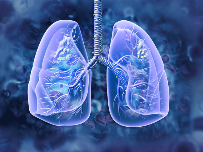 Lung cancer illustration