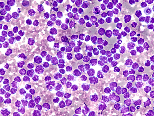 Mantle cell lymphoma 