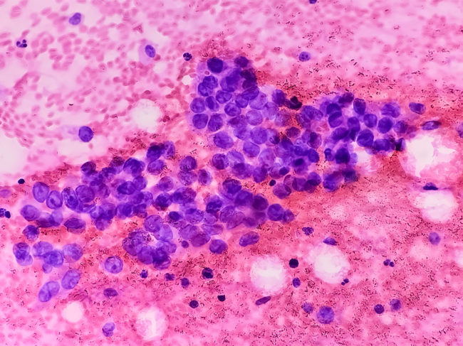 Photomicrograph of fine needle aspiration cytology of a pulmonary nodule showing adenocarcinoma, a type of non-small-cell carcinoma.