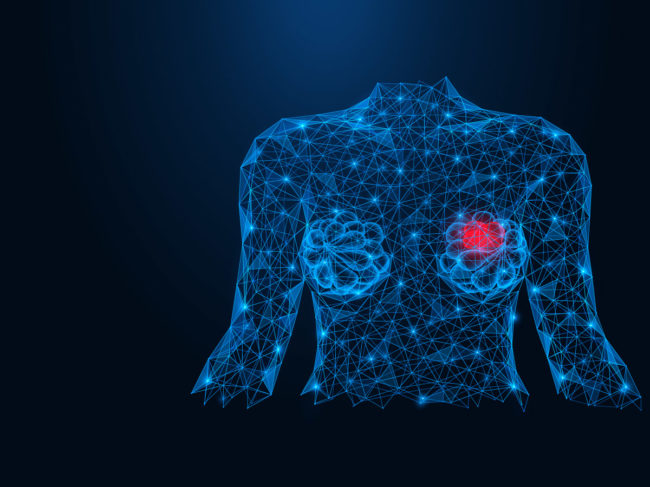 Cancer tumor in breast illustration