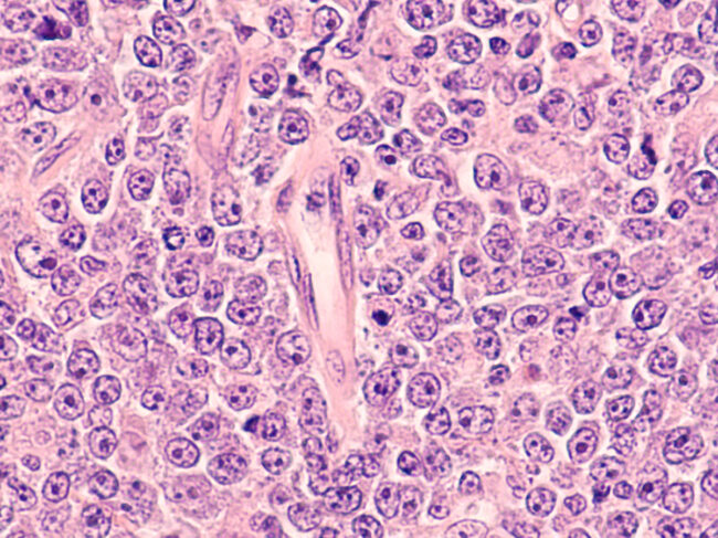 Photomicrograph of diffuse large B-cell lymphoma