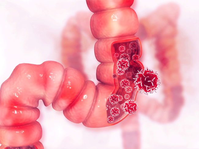 Colon cancer illustration