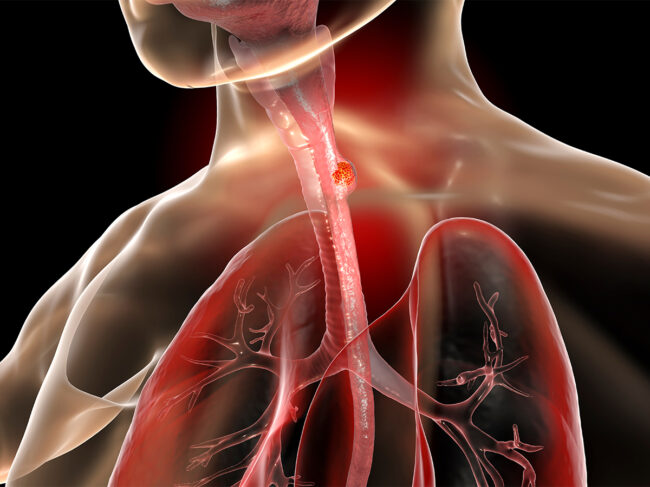 Illustration of cancer on the esophagus