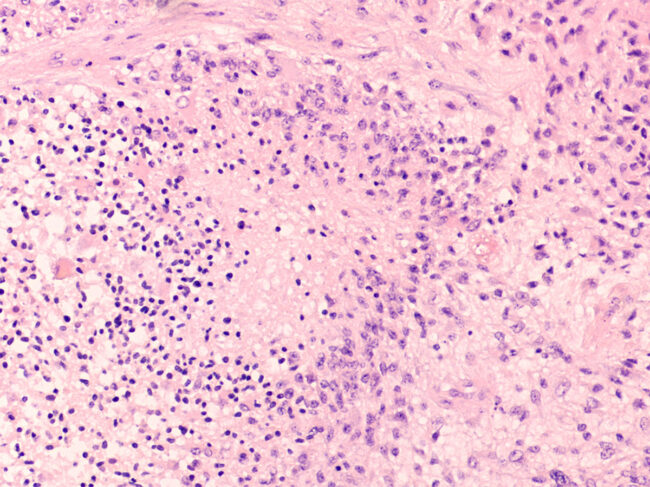 Microscopic image showing histology of a glioblastoma multiforme