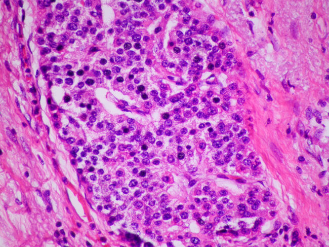 Pathology image of neuroendocrine tumor