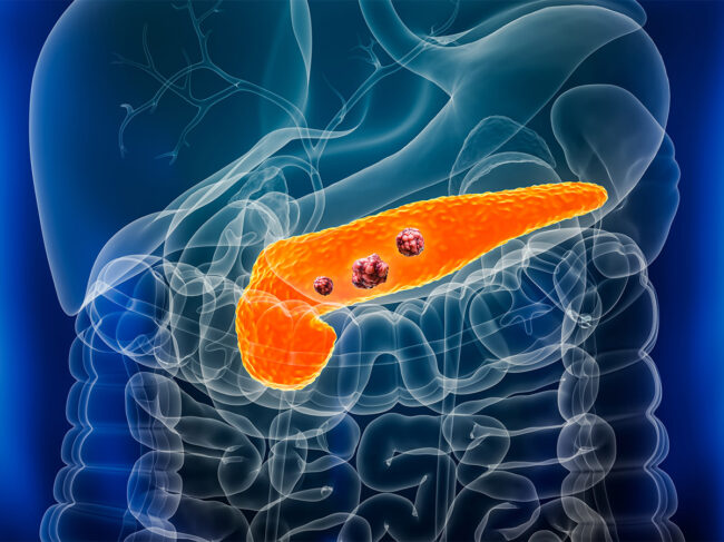 Illustration of cancer in the pancreas