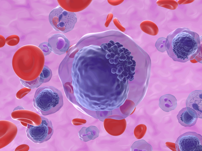 Acute myeloid leukemia