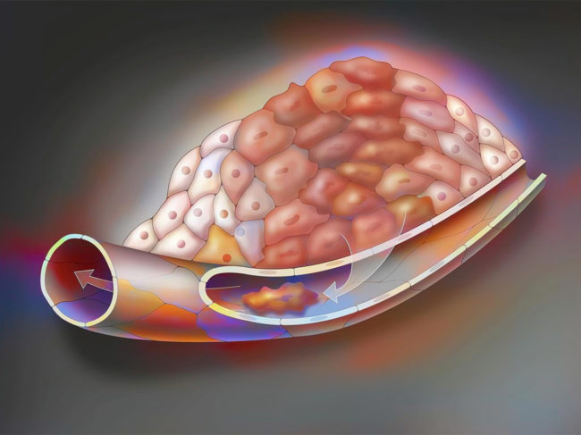 Illustration of cancer cells entering the blood stream