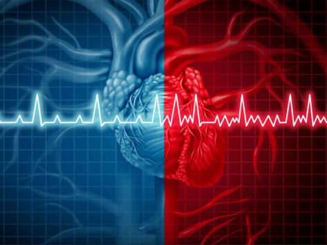 Atrial fibrillation illustration