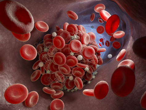 Thrombosis blood clot