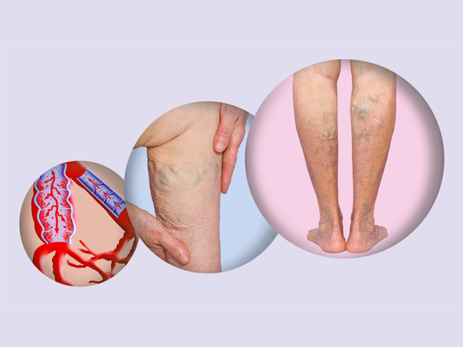 Varicose veins concept art