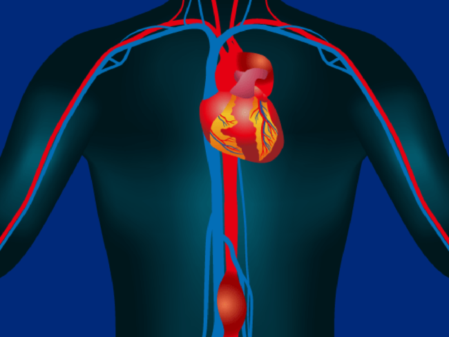 Aortic aneurysm illustration