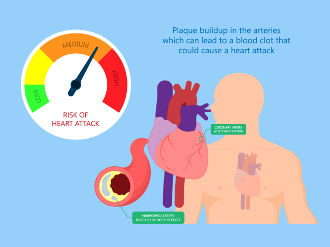 Illustration of calcified artery, heart