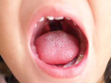 Cleft palate mouth oral