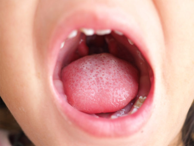 Mouth open wide showing cleft palate