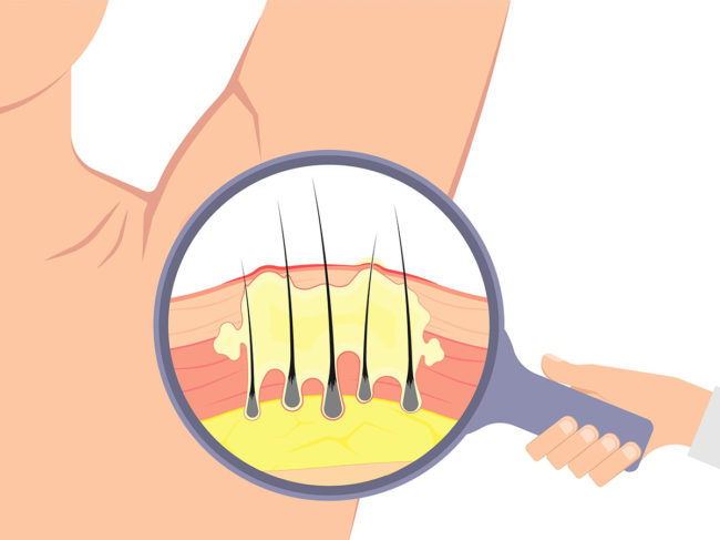 Hidradenitis suppurativa illustration