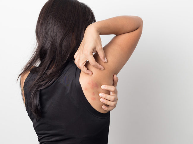 Woman scratching hives on shoulder