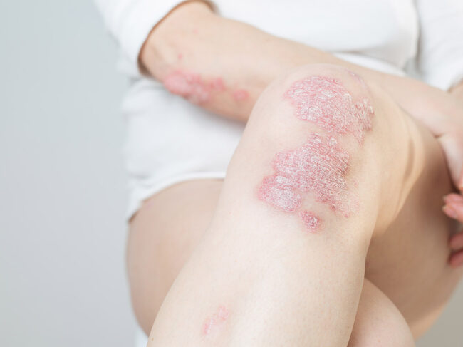 Dry, thick and raised patches on the skin of knees and elbows