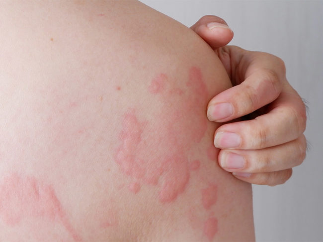 Close up image of shoulder and back with severe urticaria or hives 