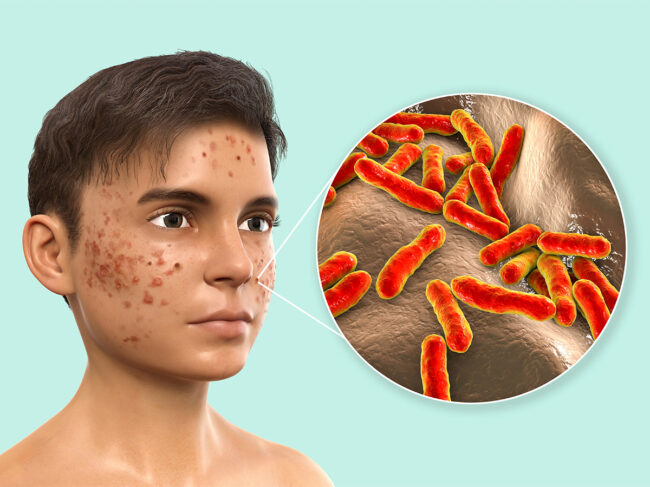 Illustration of teen boy with acne on face caused by Cutibacterium acnes