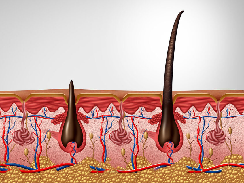 Adam17 Identified As A Pathogenic Gene In Families With Hair Loss 