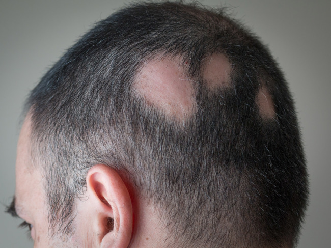 Hair loss patches on head