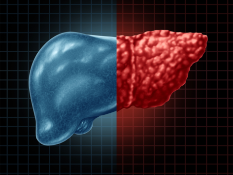 Liver disease