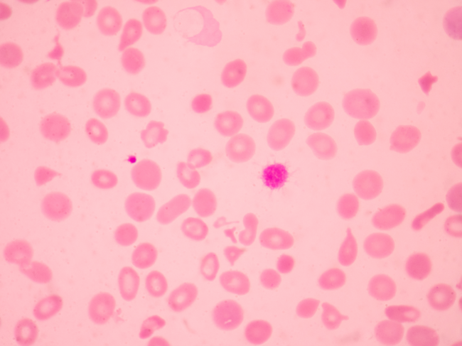 Blood smear showing abnormal red blood cells morphology