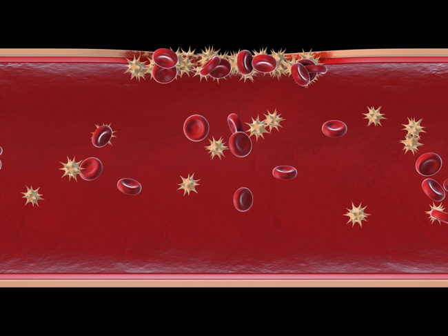 Illustration of blood vessel injury being repaired by red blood cells and platelets