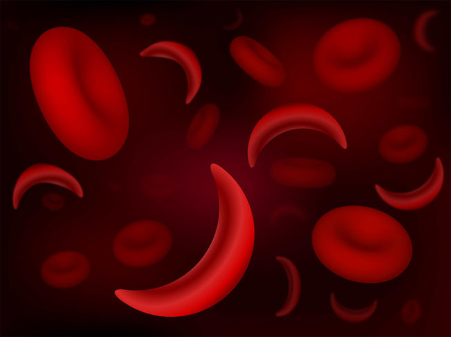 Illustration of sickle-cell and normal red blood cells