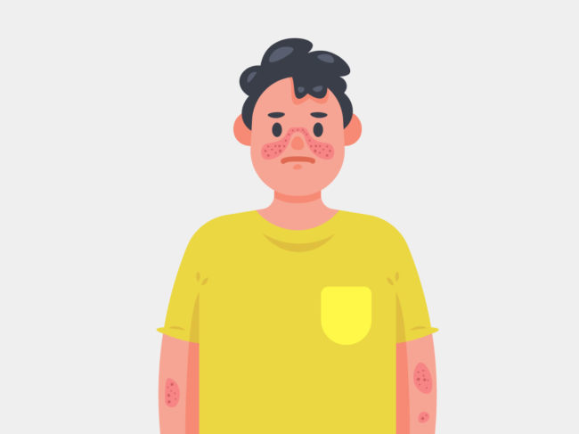 Illustration of man with systemic lupus erythematosus showing rash on face and arms
