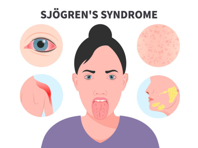 Illustration showing symptoms of Sjögren’s syndrome