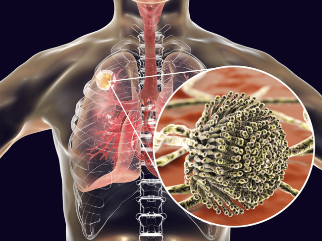 Pulmonary aspergillosis illustration