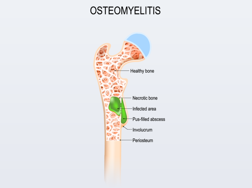 Locate Bio granted FDA breakthrough device designation for resorbable ...