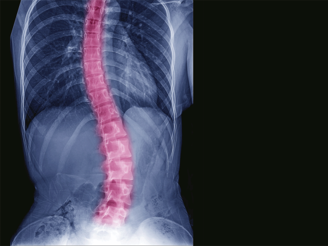 scoliosis-spine-orthopedic.png