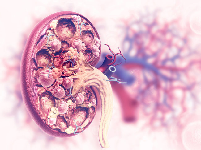 Illustration of diseased kidney