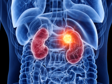 Kidney cancer tumor