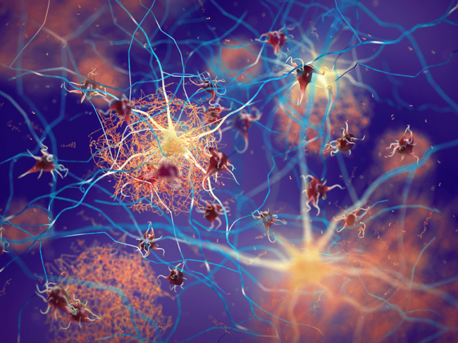 Amyloid plaques forming between neurons