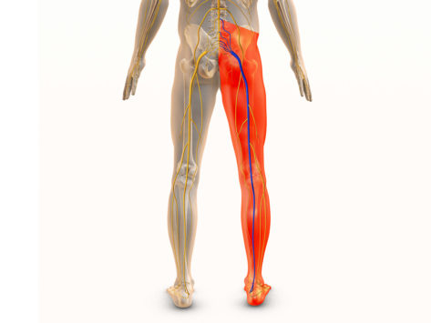 Medical art  concept for radicular leg pain or sciatic nerve pain