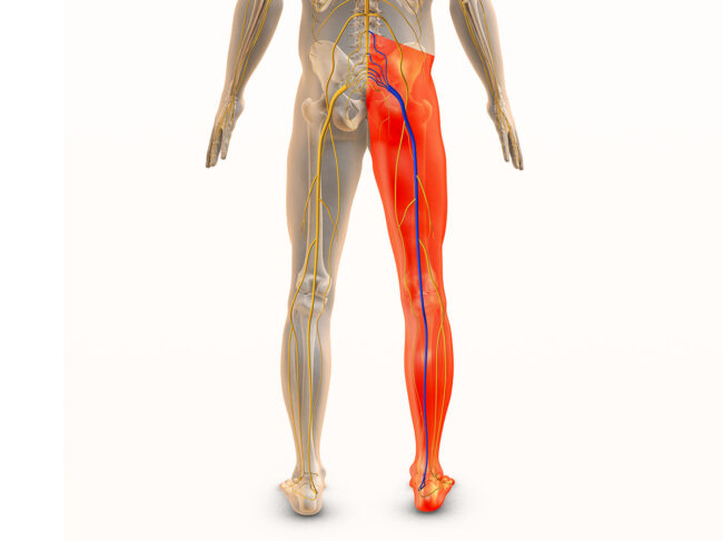 Medical art concept for radicular leg pain or sciatic nerve pain