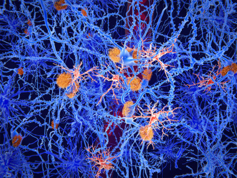 Illustration of Microglia cells (red) in Alzheimer´s disease