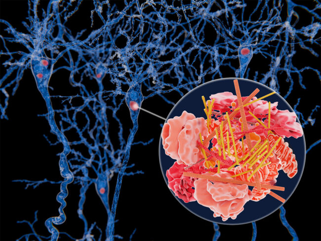 Illustration of neurons with Lewy bodies