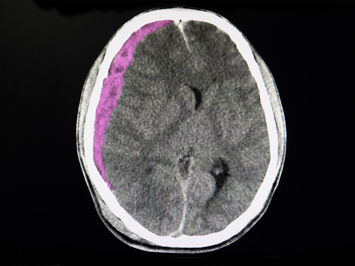 subgaleal-hemorrhage-symptoms-risks